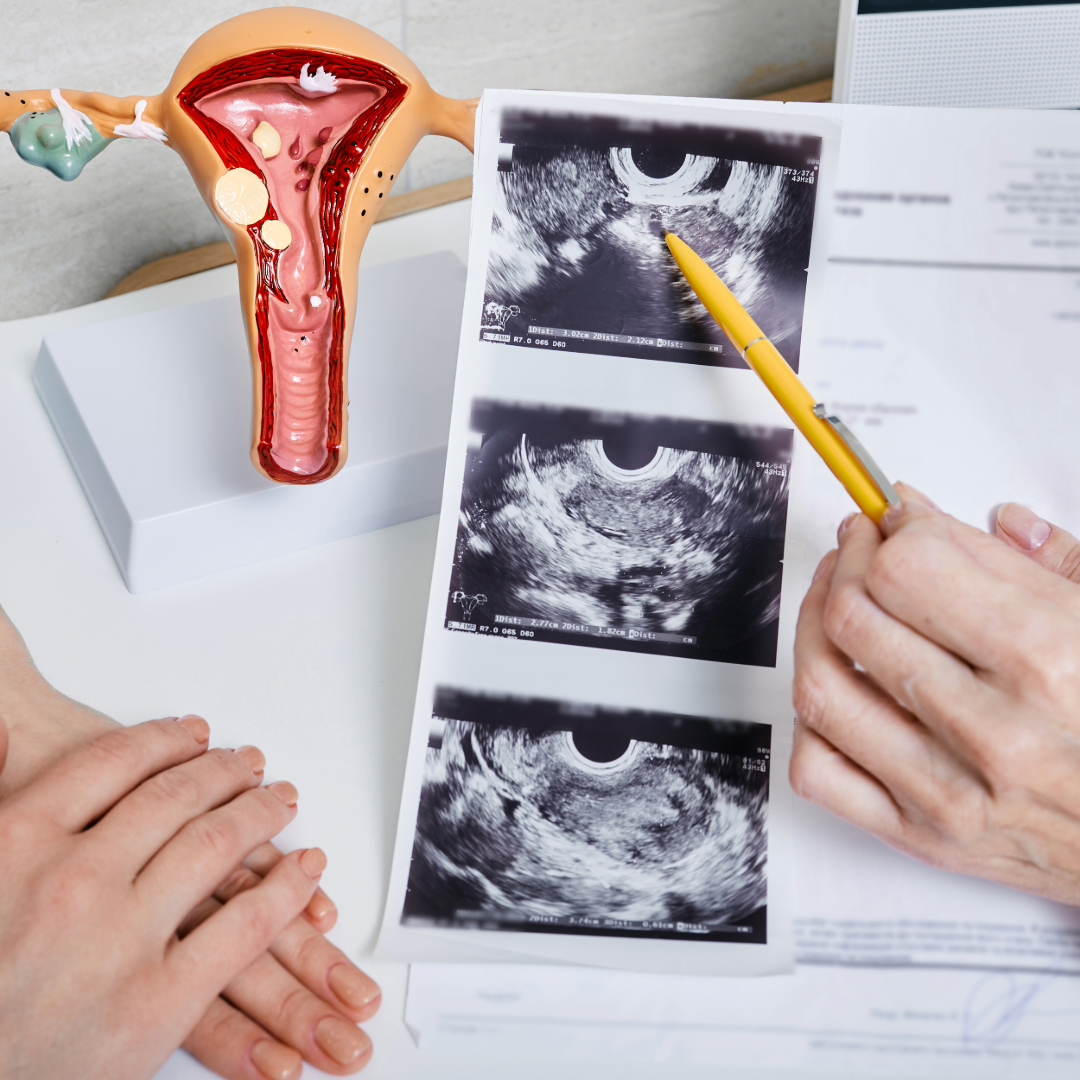 Pcod Pn Radiograph Decoding PCOD v/s PCOS – Amrutam